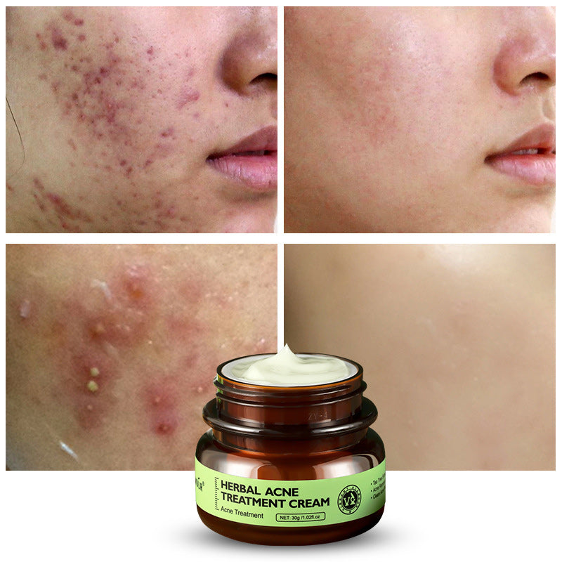 Enhanced Herbal Acne Cream