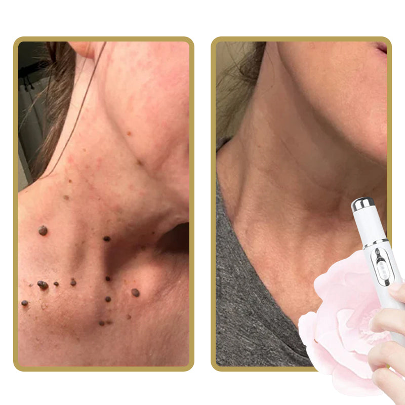 Non-Invasive Mole and Wart Removal Laser Pen