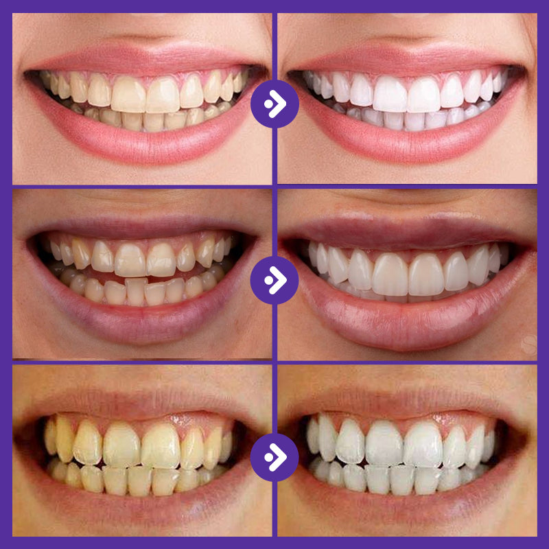 Teeth Enamel Protecting Strips