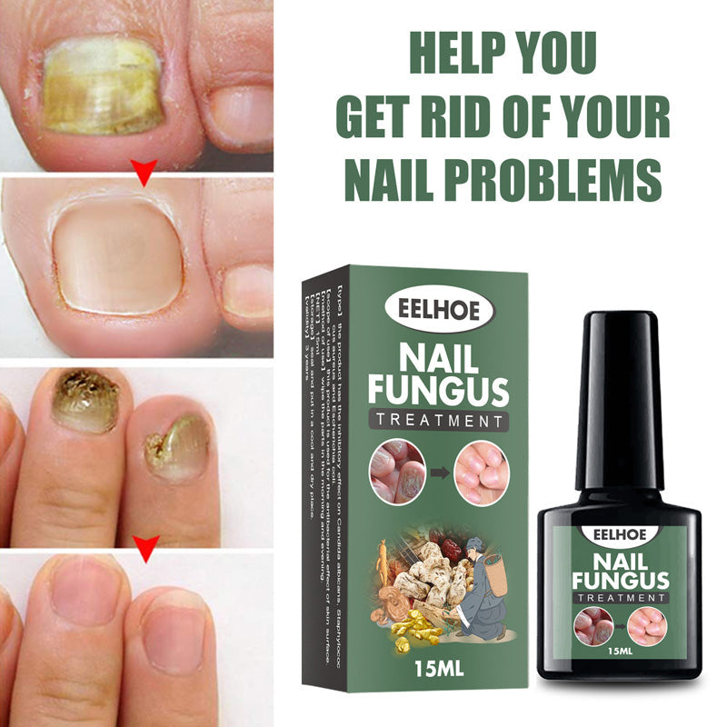 Fungal Nail Treatment